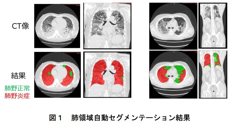 日本の胸部CT画像を元に新型コロナの診断支援AIを開発、精度83.3%達成 名古屋大ら | Med IT Tech