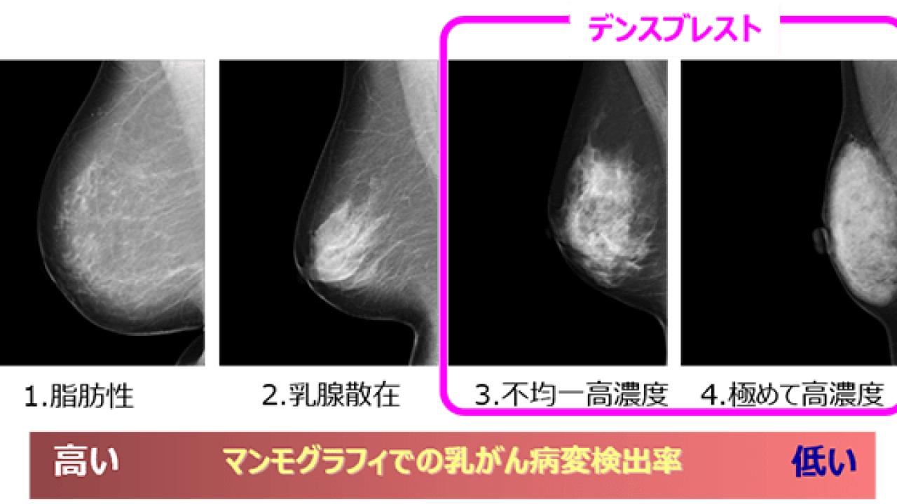 コニカミノルタ、乳腺密度を判定する画像解析ソフトウェアを開発