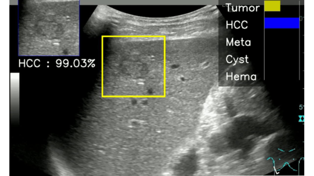 超音波画像による肝腫瘤診断aiを開発 熟練医を上回る精度を達成 近畿大 Med It Tech