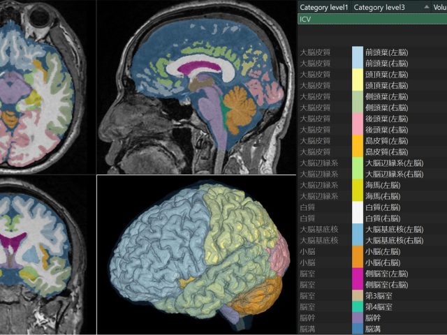 脳脊髄液容量が経年によって増えることが初めて明らかに MRI画像 